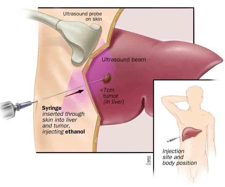 diagram of Micro Ablation